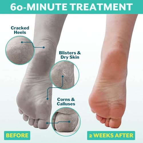 Patchology PoshPeel Foot Peeling Mask for Dry Cracked Feet - AHA & BHA