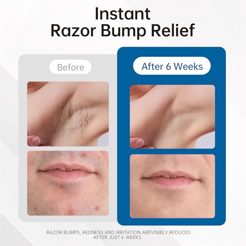 Razor Bumps Ingrown Hair Treatment Serum - 3.38oz
