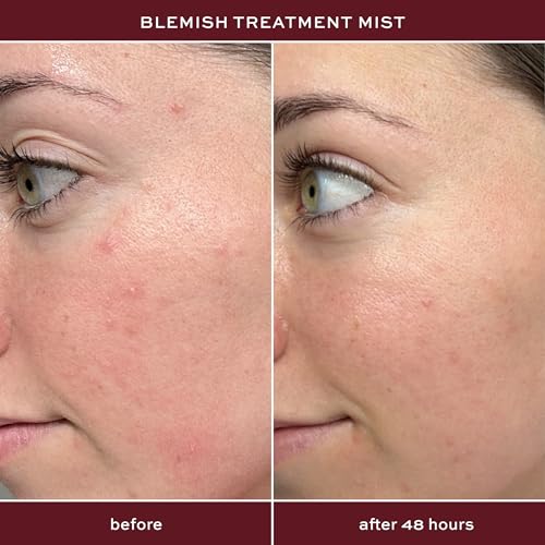 ITK Skincare 2% Salicylic Acid Spray for Face & Body Acne - Blemish-Fighting Treatment for Body Acne, Bacne, Blackheads, Pimples & Blemishes - BHA Blemish Facial Mist Post Workout - 3.3oz Spray Bottle