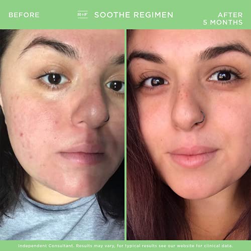 Rodan and Fields Soothe Regimen for Sensitive, Irritated Skin and Facial Redness