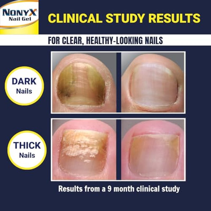 NONYX Fungal Nail Clarifying Gel – Clinically Proven for Thick, Yellow, Brittle Nails