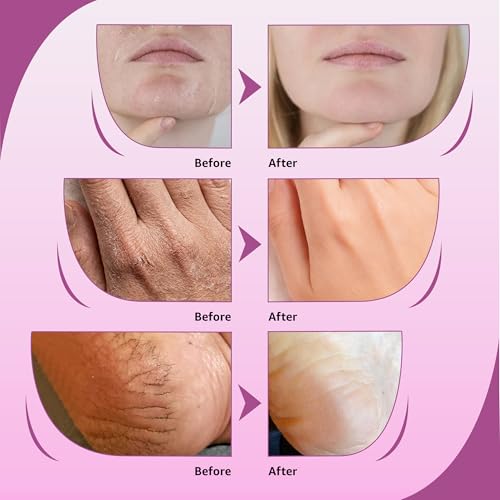 10% Urea Cream with Aloe Vera & Jojoba Oil - 150ml