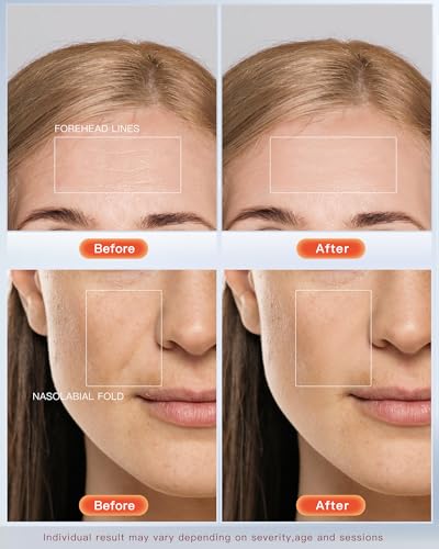 NEWKEY 4D LED Red Light Therapy Mask for Face & Acne