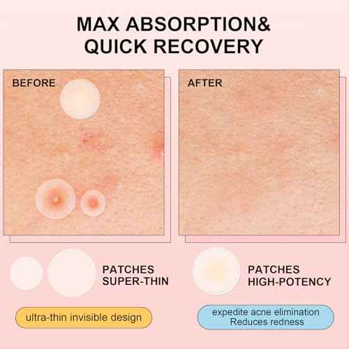 AVJONE Pimple Patches for Face(144 Patches), Hydrocolloid Acne Patches with Tea Tree Oil, pimple stickers for Breakouts, Absorbs Zit, Invisible Spot Cover and Blemish
