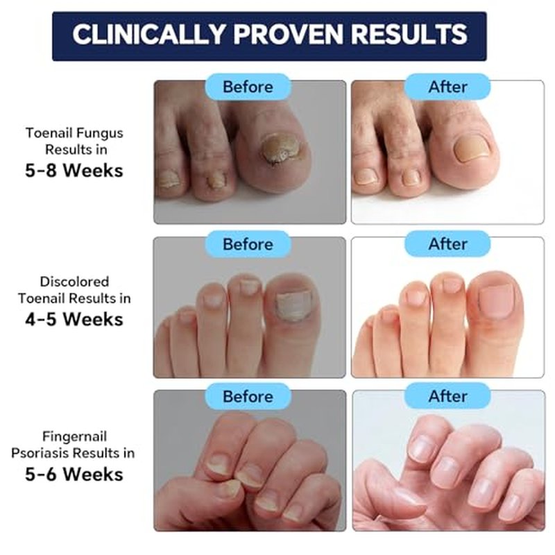 AOUGK Toenail Fungus Treatment - Extra Strength 25% Undecylenic Acid, 30ML