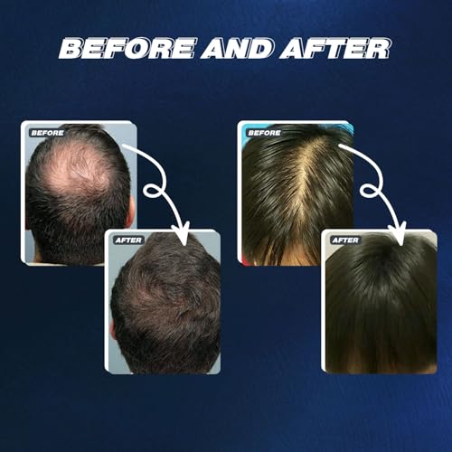 5% Minoxidil Hair Growth Serum for Men & Women - 3 Bottles