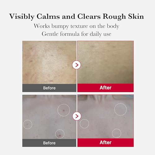 Medicube Red Body Peeling Shot - AHA BHA Exfoliating Spray 3.88oz