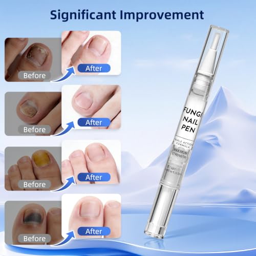 AOUGK Toenail Fungus Treatment Pen - 25% Undecylenic Acid, 4 Pack