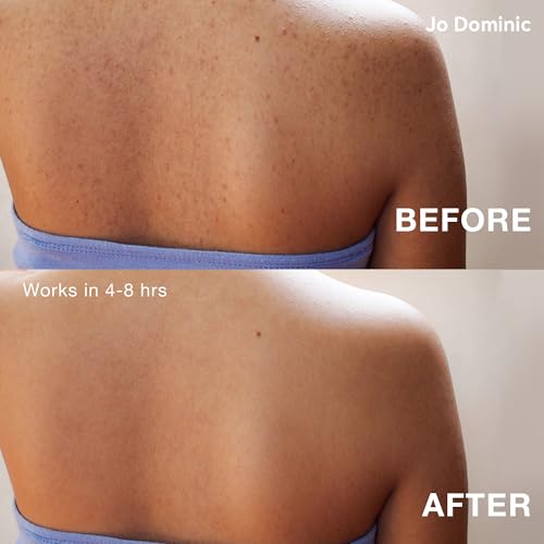 MAGIX PATCH 124 Pimple Patches by Jo Dominic?Large Pimple Patches for Face & Body, Big Acne Patches, Fits Various Areas XL Hydrocolloid Patch, Absorbs Oil & Zit Hydrocolloid Patch (7 Sizes)