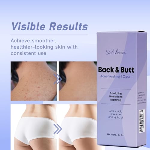 Butt Acne Clearing Cream - Maximum Strength Body Treatment