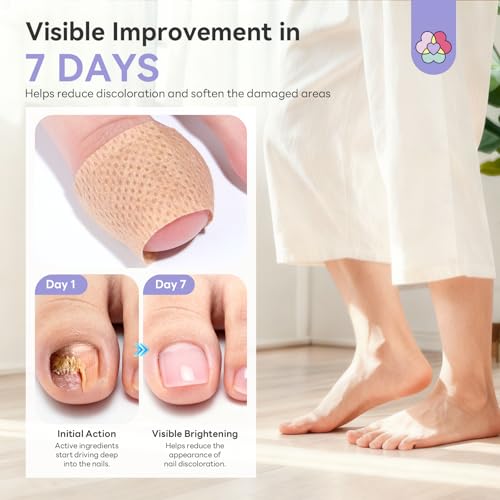 SAVILAND 1% Tolnaftate Fungal Nail Patches - Overnight Repair (32 Pcs)