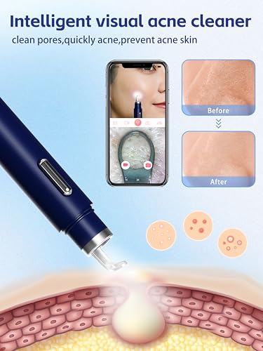 Visual Blackhead Remover with Camera 20X Extractor Kit for