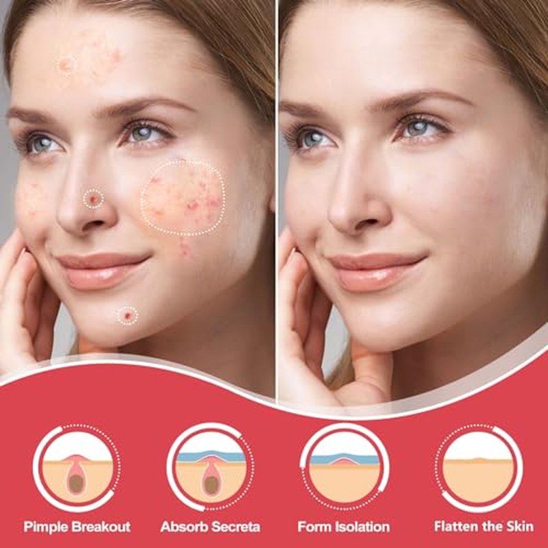 432 Counts Pimple Patches for Face, Hydrocolloid Acne Patches Zit Patches for Face Acne Spot Treatment Patch Cystic Acne Treatment Stickers Blemish Hydrocolloid Patches for all Skin Type