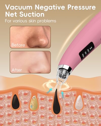Pore Vacuum Blackhead Remover - 5 Attachments & 3 Suction Levels