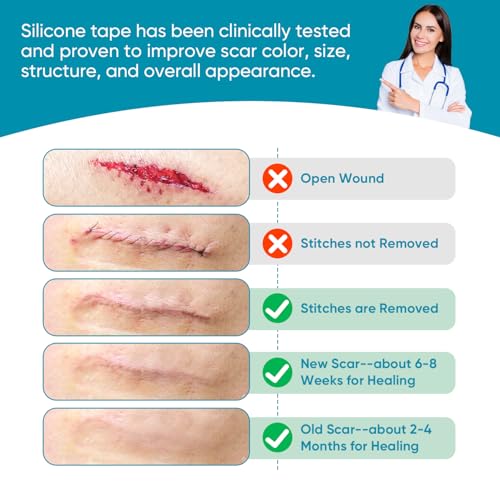 Silicone Scar Tape, Silicone Scar Sheets for Surgical Scars (1.6"x 80" Roll-2M), Medical Ggrade Scar Tape for Scars, Keloid, Acne Scars, Burn, C-Section, Stretch Marks Scars Away