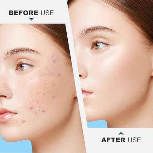 Stainless Steel Blackhead Remover, Pimple Extractor, Pimple Popper, Comedone Extractor, Surgical Grade Acne Treatment Tool, 3rd Generation Blemish Removal Kit for Face, Nose, T-Zone, 2Pcs