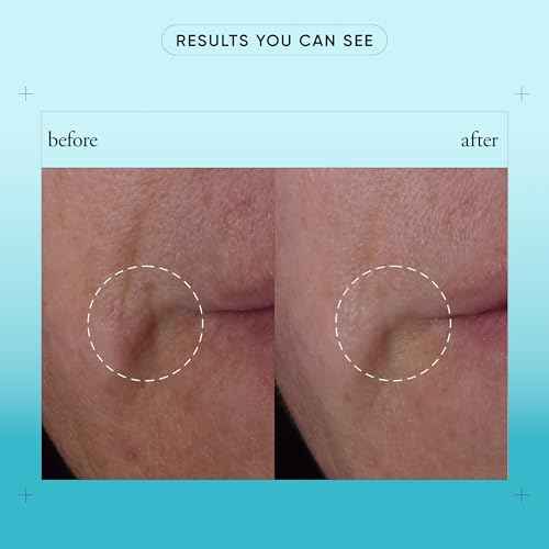 philosophy dose of wisdom bouncy skin reactivating facial serum - with hyaluronic acid, vitamin C & a patented vitality booster - delivers skin that is bouncy, plumped & radiant in one week