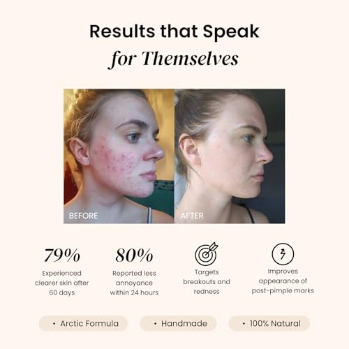 Clear Skin Balm? Ultimate Night Formula for Breakouts, Pimples and Blemishes ? Helps Fade Marks and Uneven Tone ? Prevents New Pimples ? Softens Fine Lines and Enlarged Pores