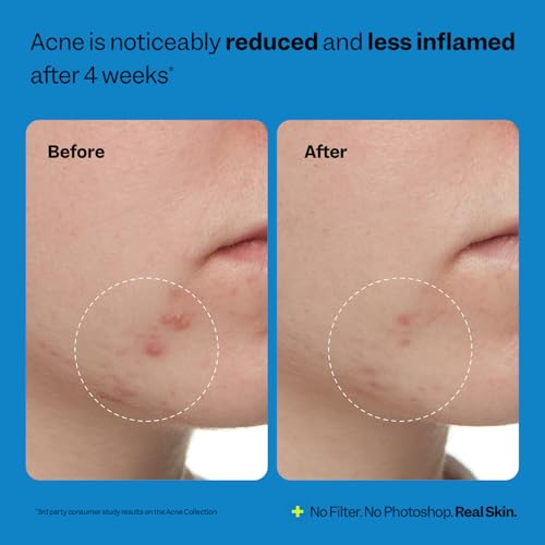 Peach Slices - Acne Exfoliating Toner (4.05 oz) - 2% Salicylic Acid Acne Treatment - Clear & Prevent Breakouts - Lactic & Glycolic Acid - Cucumber - Vegan, Cruelty Free, Korean Skin Care & Beauty