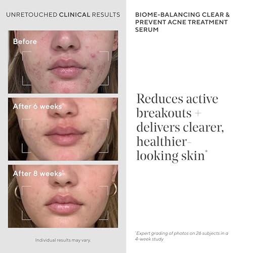 Murad Biome-Balancing Acne Treatment ? Salicylic, Mandelic, and Glutamic Acid Serum for Clearing and Preventing Breakouts, Decongesting Pores, and Balancing Skin Microbiome ? 1.0 Fl Oz