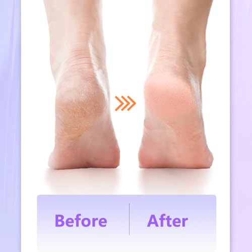 Electric Callus Remover with Dual Grinding Heads - USB Powered