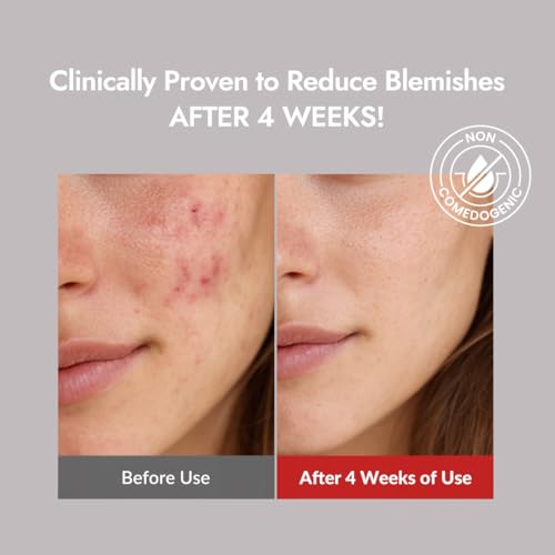 MIZON Goodbye Blemish Fresh Toner, BHA, Niacinamide for Excessive Sebum, Troubled Skin, Acne Treatment, Breakout Treatment, Korean Skincare, Acne Spot Treatment, Smooth Skin (120ml/4.05 fl. oz.)