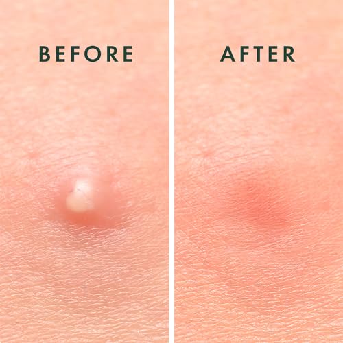 Rael Invisible Hydrocolloid Acne Pimple Patches 96 Ct - Clear, Hypoallergenic, 2 Sizes (10mm & 12mm) - Discreet Skin Cover
