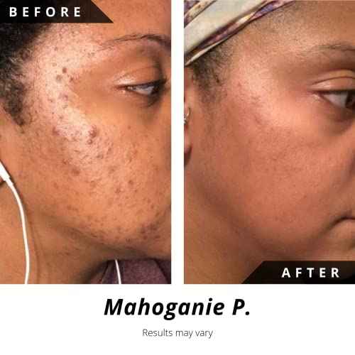 Noir D'or Acne Scar Treatment, Hyperpigmentation Treatment for Face, Normal to Oily Acne Skincare | Three Step Scar Repair Set for Acne Scars and Dark Spot Remover | Breakout Acne Treatment for Scars