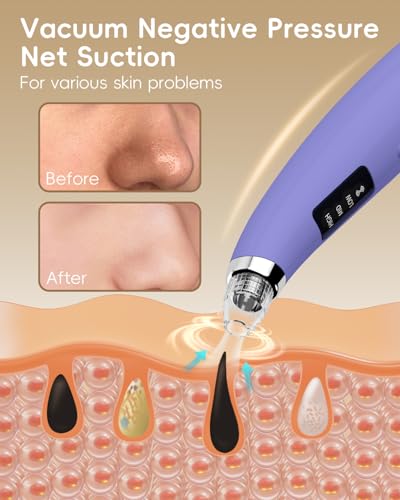 Pore Vacuum Blackhead Remover - 5 Attachments & 3 Suction Levels