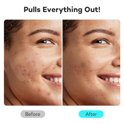 LitBear Large Pimple Patches for Face (6 Sizes 401 Counts), Big Hydrocolloid Acne Patches, XL Hydrocolloid Bandages for Body, Cheek, Forehead, Chin, Full Face, Back, Nose