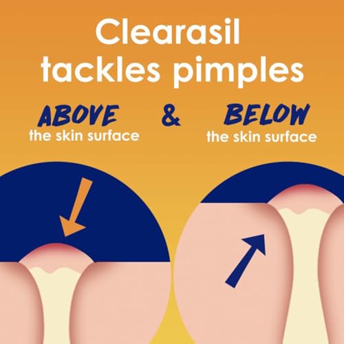 Clearasil Stubborn Acne Control 5in1 Exfoliating Wash 6.78 fl. oz., Reduces Blocked Pores, Pimple S (Pack of 5),6.78 Fl Oz (Pack of 5)