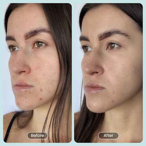 30 DAY MIRACLE BHA 20% Peeling Solution - Clinical Strength BHA Liquid Exfoliant for Clogged Pores, Wrinkles & Blackhead Remover - Salicylic Acid Serum & Chemical Exfoliant for Face Peel 1oz