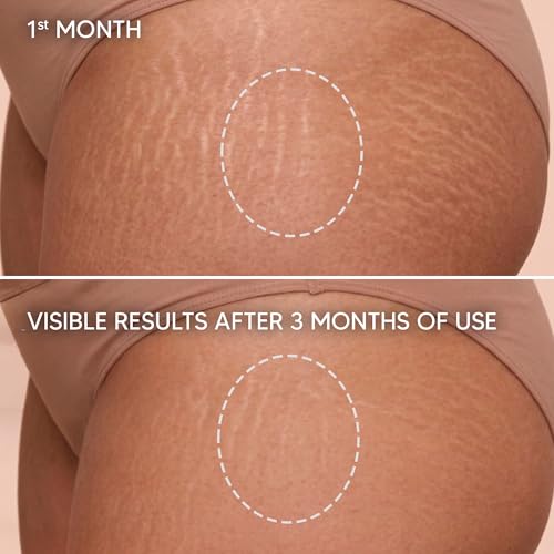 Cicatrissim Stretch Mark Cream - Red & White Striae 150g