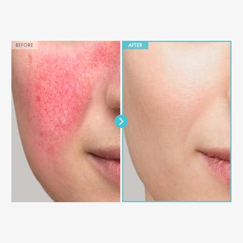 TOSOWOONG Zinc Oxide Cream 10% - Acne & Redness Relief, 50g
