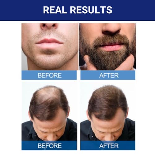 Kirkland Signature 5% Minoxidil Hair Regrowth for Men - 1 Month Supply