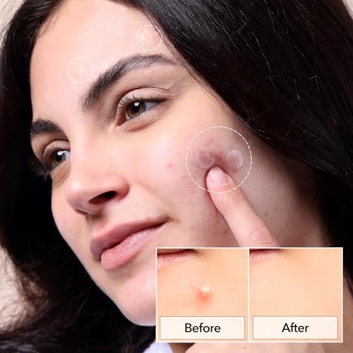 FreeGo Invisible+ Hydrocolloid Spot Pimple Patches for Face, Large Patches for Breakouts, Zit, Blemish Spot, Facial Stickers, Korean Pimple Patches (132 Counts)