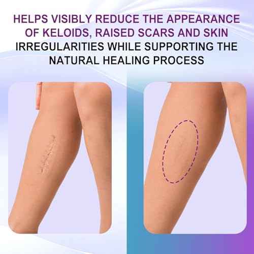 Silicone Scar Gel, Intensive Scar Cream, 2.1oz Keloid Bump Removal for Stretch Marks Removal, Surgical Scars, Cesarean Section, Acne, Injury, Burns, Doctor-tested Scar Improvement (60g)