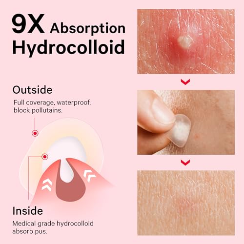 Sosky Hydrocolloid Pimple Patches with Salicylic Acid - 30 Count