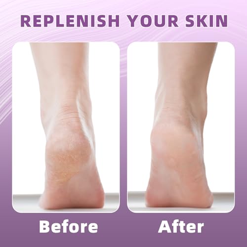 Moisturizing Heel Socks for Cracked Feet - Gel Toeless Foot Therapy, 2 Pairs