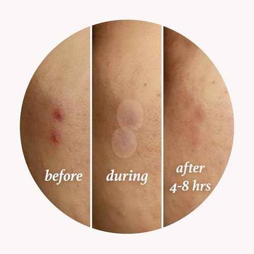 Julep Patch Me Up Waterproof Pimple Patches for Face ? 72 Hydrocolloid Clear Acne Patches with Tea Tree Oil, Ultra-Thin Acne Stickers, Reduces Blemishes & Scarring ? 48 8mm & 24 12mm Patches