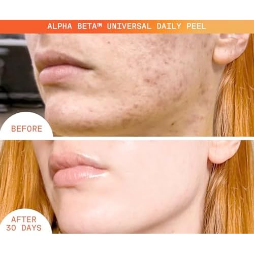 Dr Dennis Gross Alpha Beta Universal Daily Peel: for Uneven Tone or Texture and Fine Lines or Enlarged Pores, (5 Treatments)