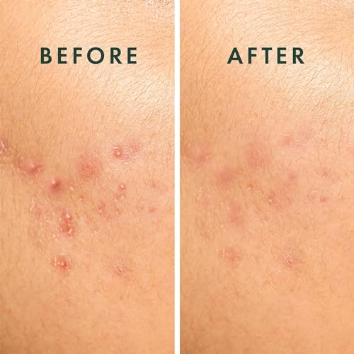 Rael Pimple Patches, Miracle Spot Control Cover - Hydrocolloid Acne Pimple Patch, Strips for Zits and Blemish, Korean Skin Care (20 Count)