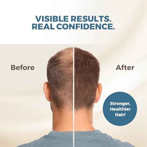 HAIRMETTO Saw Palmetto Extract Serum for Hair Loss, Hair Growth Serum with Stinging Nettle, Rosemary Oils and Peppermint Scent, Hair Serum for Men and Women - 4oz (118ml)