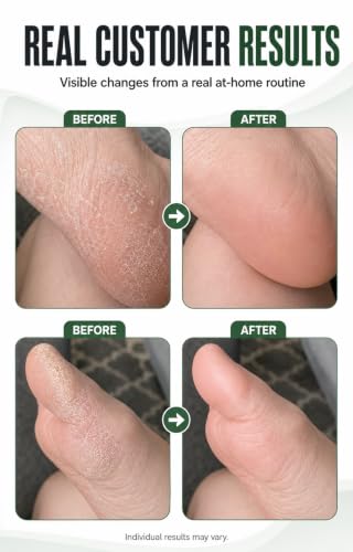 Moisturizing Gel Socks for Dry Cracked Feet - Size 10