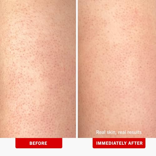 First Aid Beauty - KP Bump Eraser Body Scrub with 10% AHA, Keratosis Pilaris Skin Exfoliater with Glycolic and Lactic acids, Helps Reduce Chicken Skin Bumps, Safe for Sensitive Skin, 8 oz + Bonus, 2ct