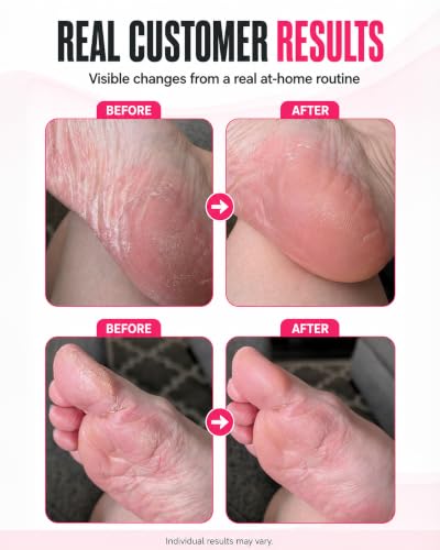 Moisturizing Gel Socks for Dry Cracked Feet & Heels