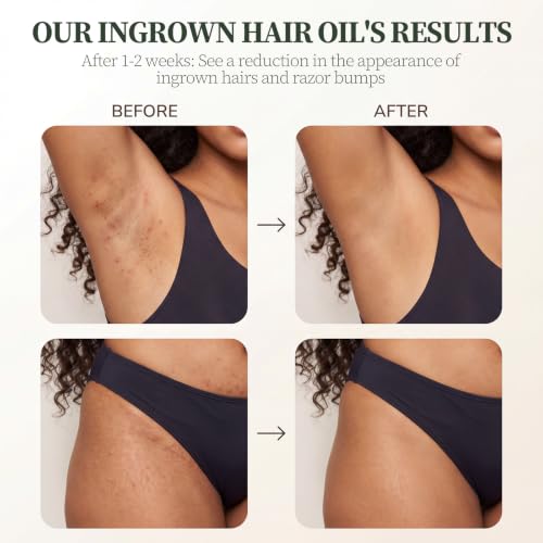 Ingrown Hair Treatment Oil - Tea Tree & Jojoba, 1oz