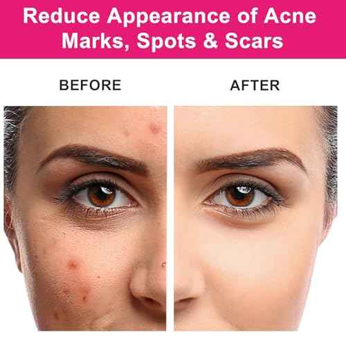 Organic Rosehip Seed Oil for Face, USDA Certified, Cold Pressed, Unrefined, 100% Pure Natural Rose Hip Oil (1oz / 30ml) for Anti-Aging, Acne Scar Treatment, Skin & Hair Care, Gua Sha Massage