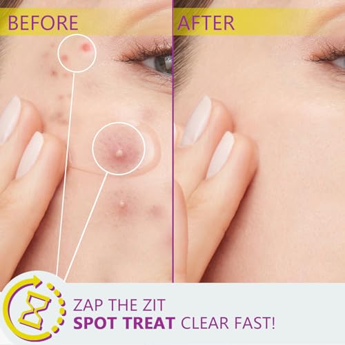 Azelaic Acid, 12% Azelaic Acid For Face Serum Rich in Niacinamide and Hyaluronic Acid, Fades Post Acne Marks and Calms Redness, Formula for Uneven and Blemish Prone Skin Care 1 OZ