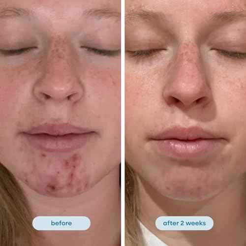 Hypochlorous Acid Daily Facial Spray for Sensitive Skin - HOCL Toner Helps Calm Redness, Acne and Breakouts. Supports Eczema-Prone and Acne-Prone Skin. 4 Fl Oz